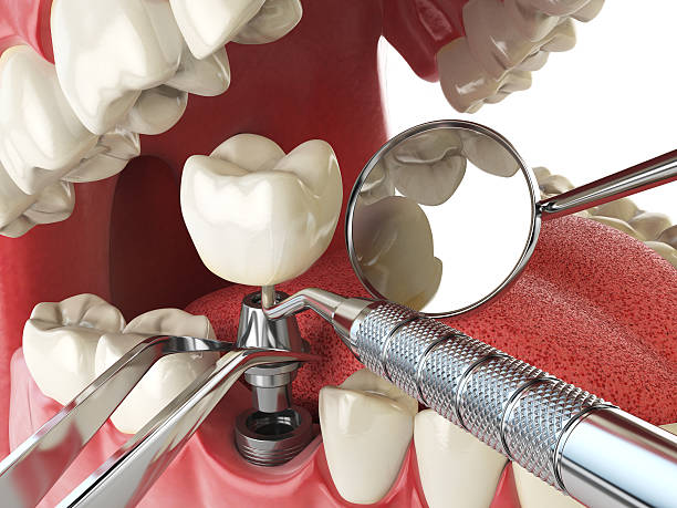 Best Emergency Dental Care for Broken or Chipped Teeth in Mino, CA